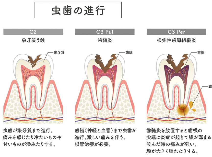 岩国市、歯医者、虫歯の進行